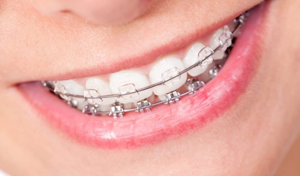 Names For Braces